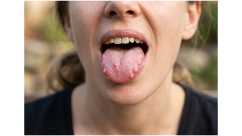 Close-up of lie bumps on the tongue showing small inflamed red bumps caused by transient lingual papillitis.
