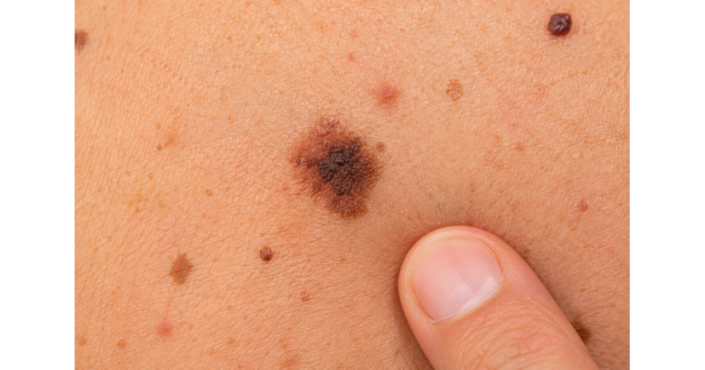 Skin cancer warning signs shown as a suspicious irregular dark mole on the skin