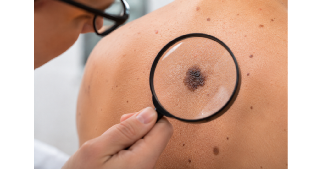 Close-up of a suspicious dark irregular mole being examined for melanoma