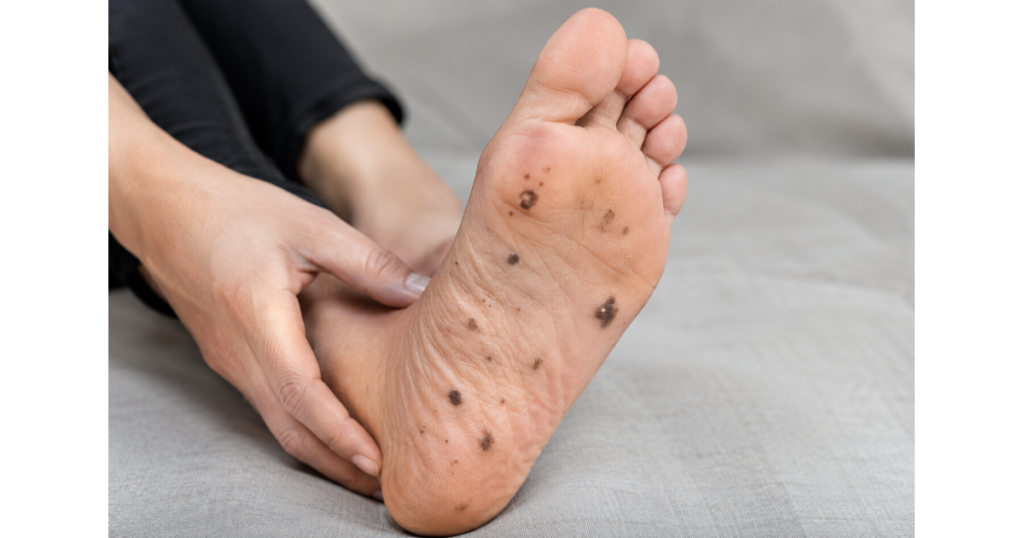 Black spots on the sole of a foot