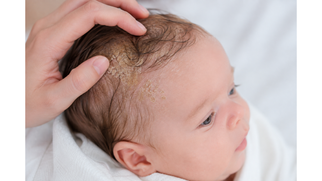 Baby with cradle cap on the scalp
